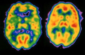 PET scans of a schizophrenia sufferer's brain (left) and normal brain (right).
